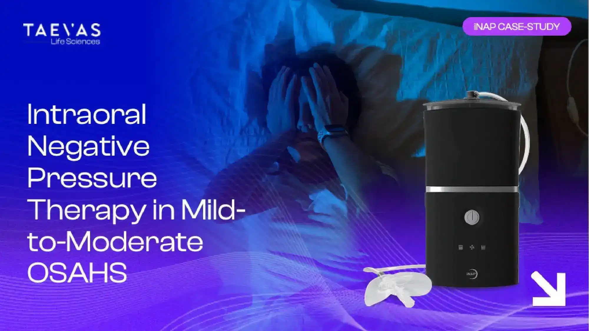 Intraoral Negative Pressure Therapy in Mild-to-Moderate OSAHS