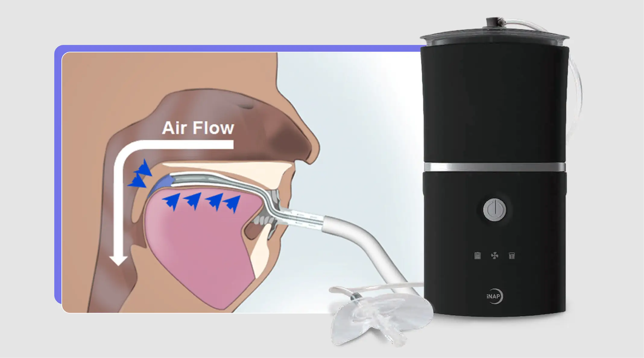 The Science Behind the iNAP Device: FDA-Cleared CPAP Alternative for Obstructive Sleep Apnea